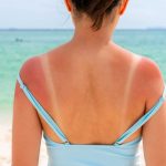 Sonnenbrand – Lebensmittel für den natürlichen Hautschutz von innen